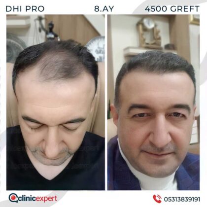 Clinicexpert Saç Ekimi Öncesi ve Sonrası 4