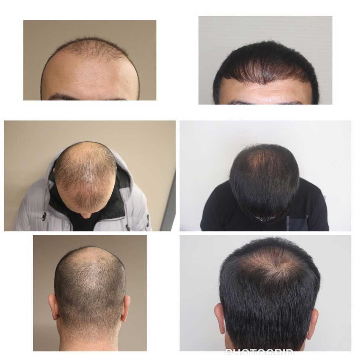 Serdar Gökrem Saç Ekimi Öncesi ve Sonrası 1