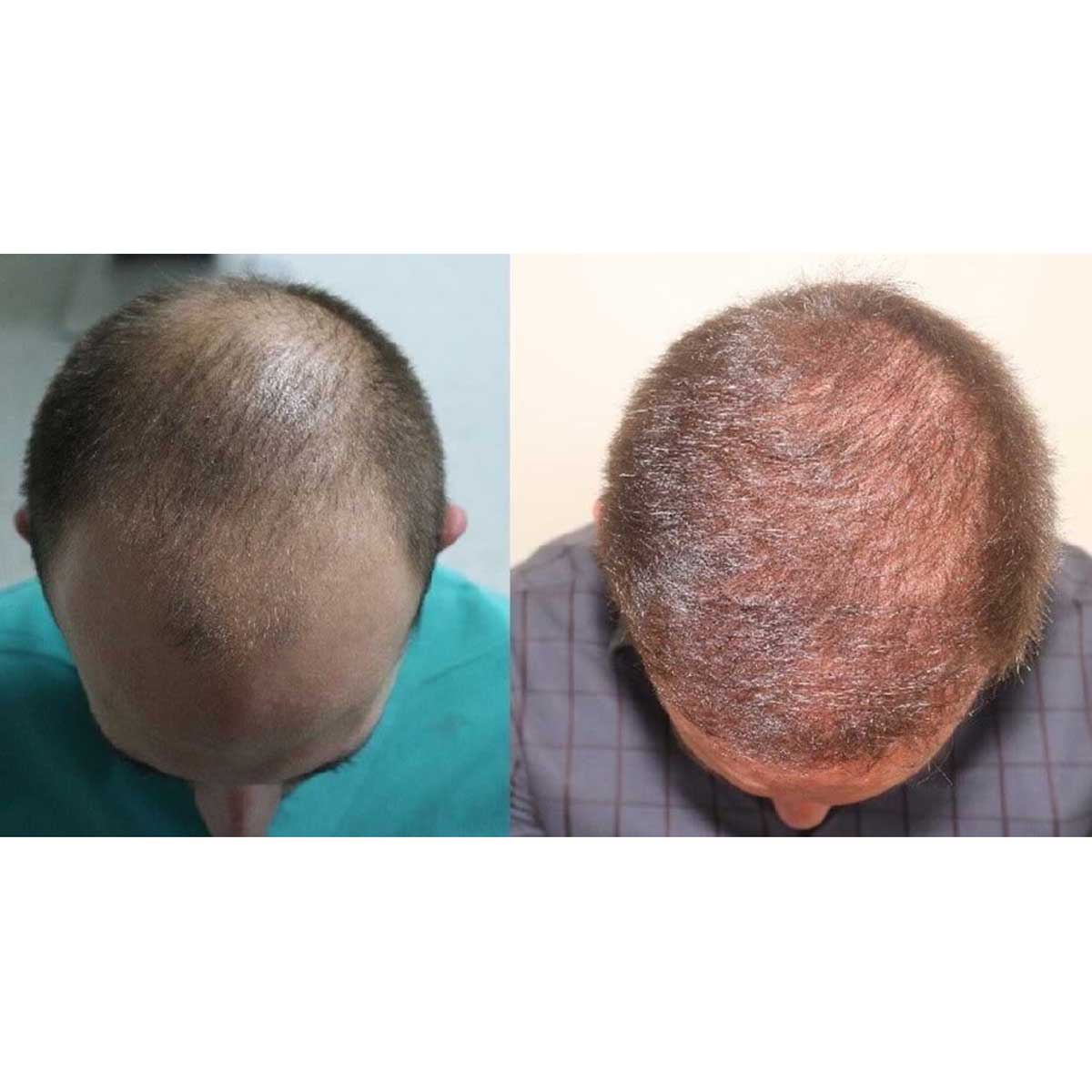 Serdar Gökrem Saç Ekimi Öncesi ve Sonrası 4