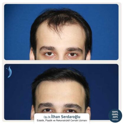 İlhan Serdaroğlu Saç Ekimi Öncesi ve Sonrası 3