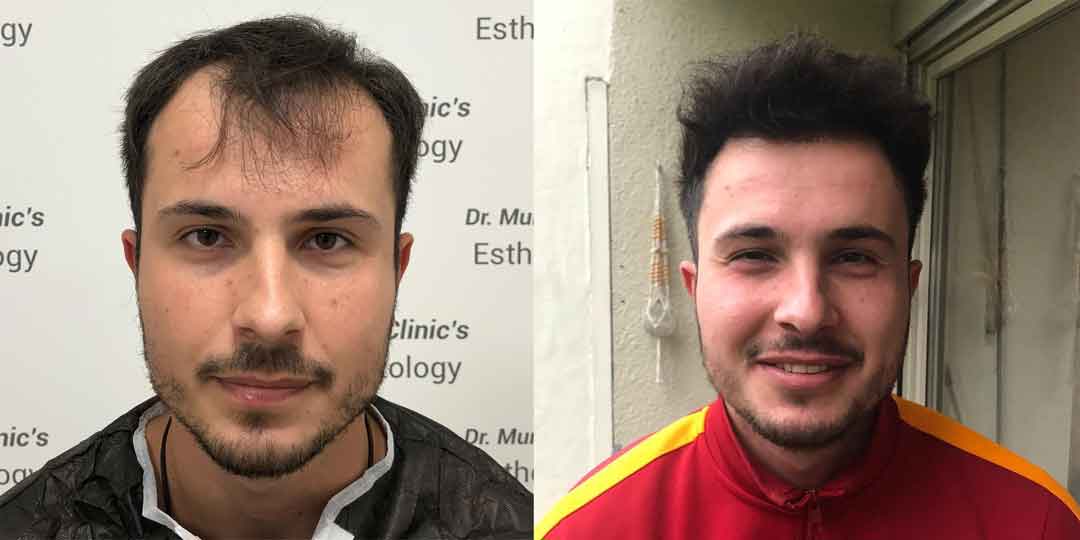 Dr. Murat Küçüktaş Saç Ekimi Öncesi ve Sonrası 1