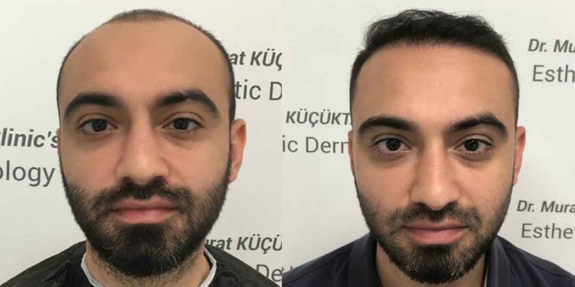Dr. Murat Küçüktaş Saç Ekimi Öncesi ve Sonrası 3