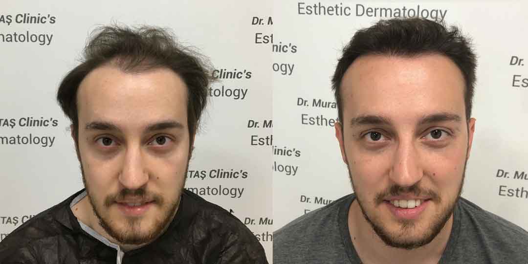 Dr. Murat Küçüktaş Saç Ekimi Öncesi ve Sonrası 4